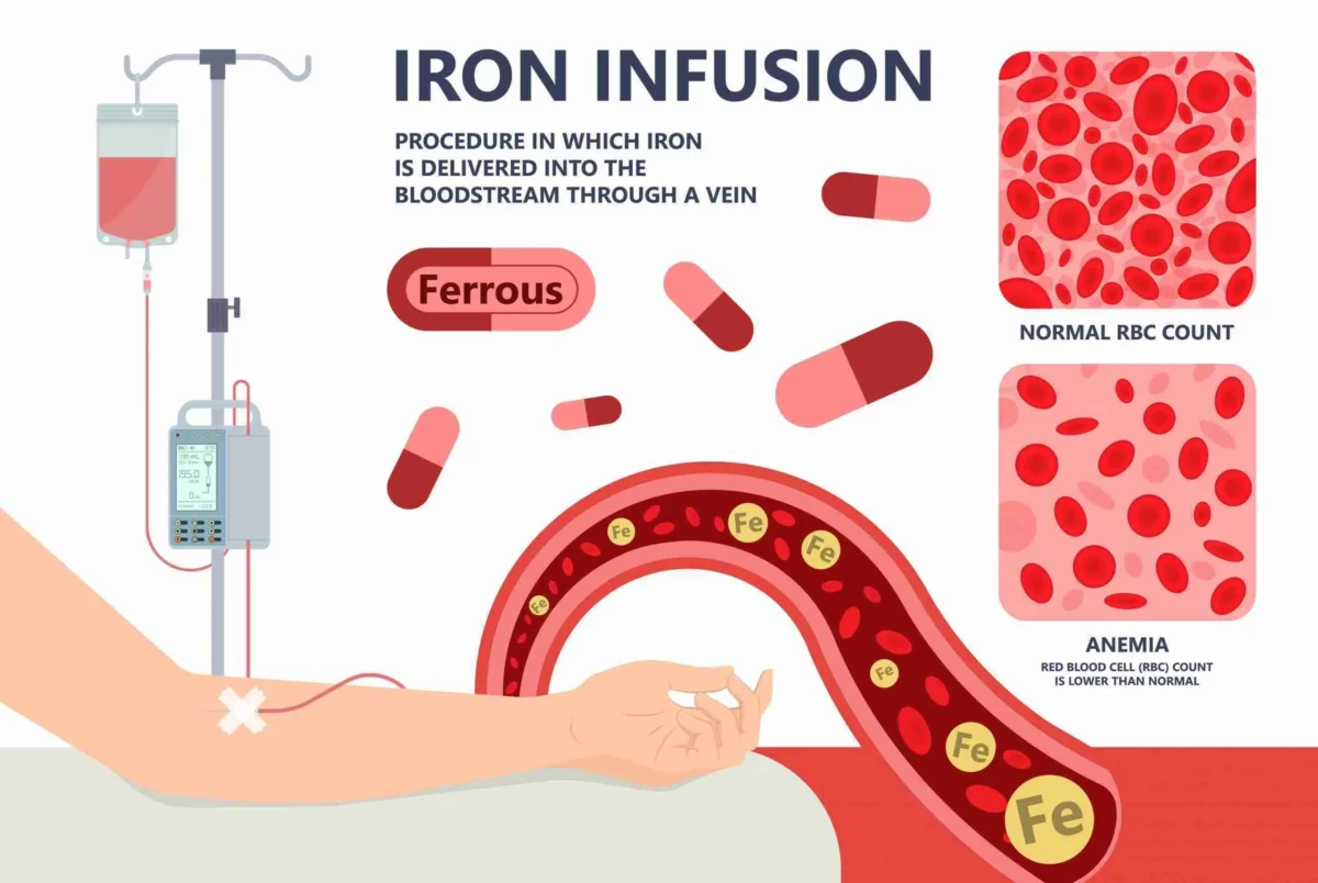 Iron Infusion Graphic